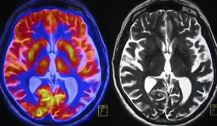 brain injury scan