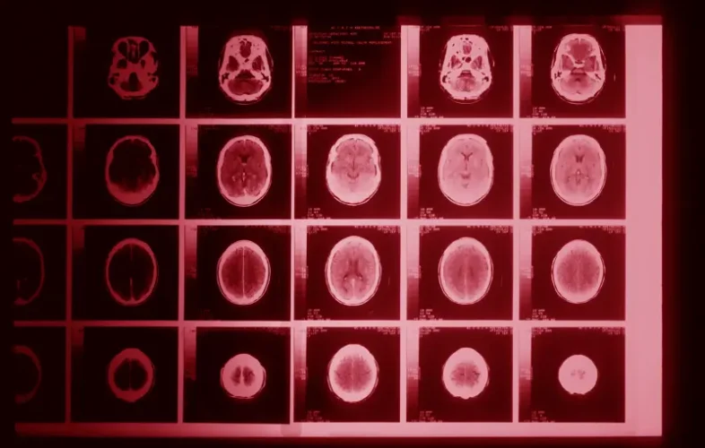 A brain injury occurs when an outside force affects the brain. This may result from a direct blow to the head, or from a sudden movement of the head and neck