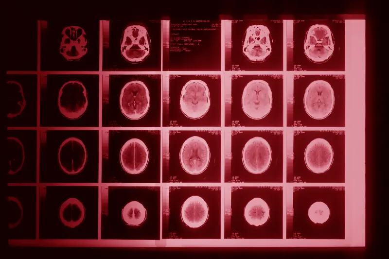 A brain injury occurs when an outside force affects the brain. This may result from a direct blow to the head, or from a sudden movement of the head and neck